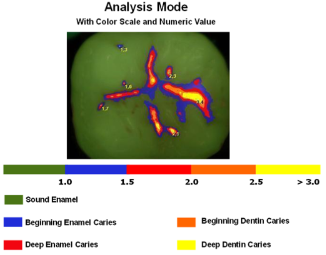 Dentist in Ashburn VA | Green CT, Laser Cavity Finder and Early Orthodontics