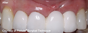 Dentist in Ashburn VA | Frenectomy, Alternatives to Orthodontics and Nasal Breathing Program