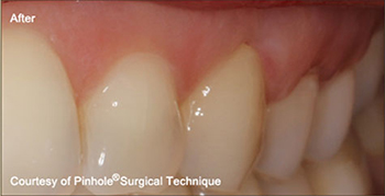 Dentist in Ashburn VA | Laser Cavity Fix, Take Home Sleep Study and Sleep Apnea Solutions