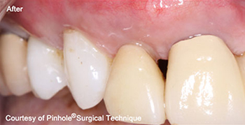 Dentist in Ashburn VA | Nasal Breathing Program, Laser Cavity Finder and Nu Calm reg