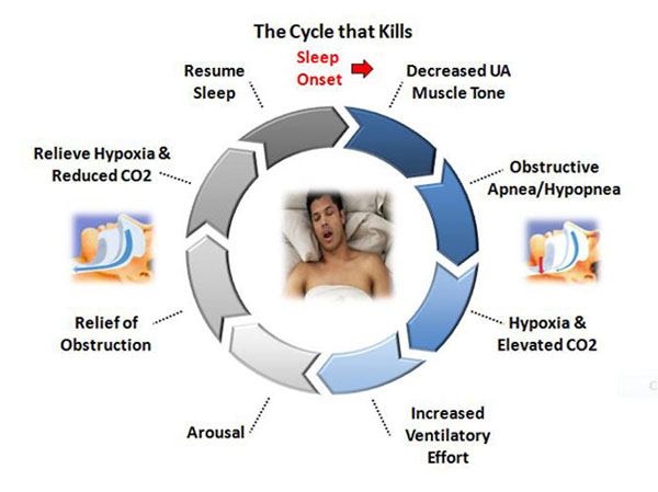 Dental Solutions for Obstructive Sleep Apnea - Hibiscus Dental