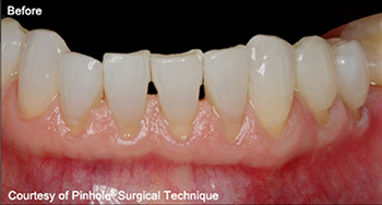 Dentist in Ashburn VA | Nu Calm reg , Mercury Free and NuCalm reg