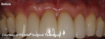 Dentist in Ashburn VA | Nu Calm reg , Cold Sores amp Canker Sores and Early Orthodontics