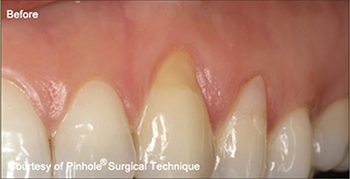 Dentist in Ashburn VA | Sleep Apnea Appliances, Low Level Laser Therapy and Laser Cavity Finder