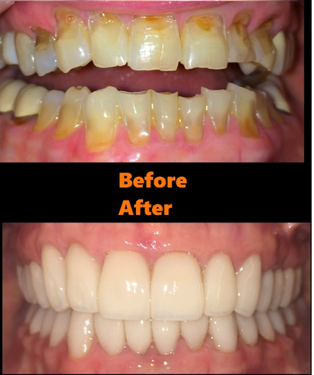 Dentist in Ashburn VA | Recession Treatment, Oral Cancer Screening and NuCalm reg