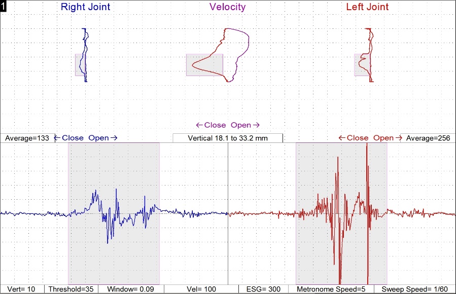Dentist in Ashburn VA | Low Level Laser Therapy, Digital Bite Analysis and Mercury Free